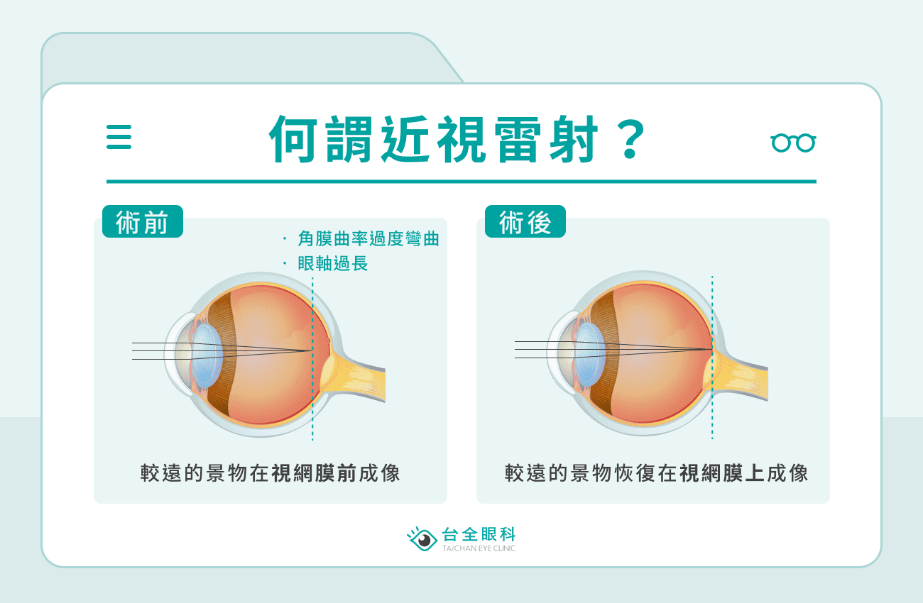 何謂近視雷射？