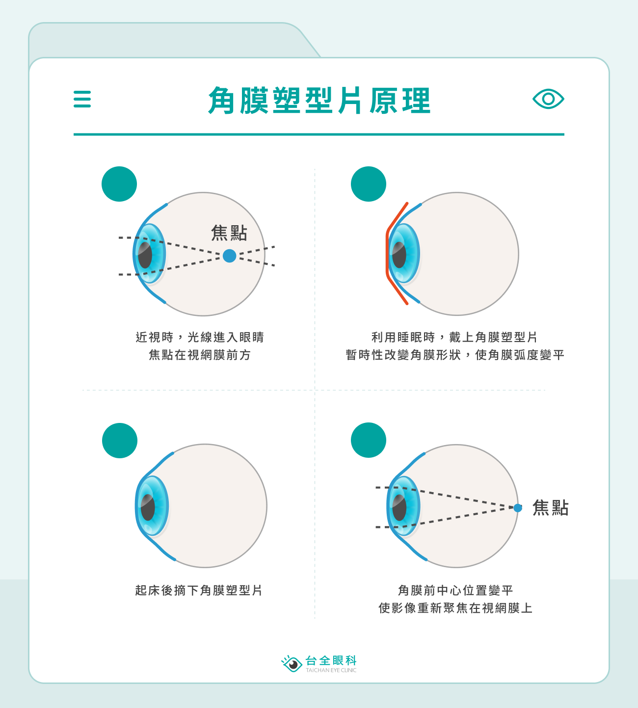 角膜塑型片原理