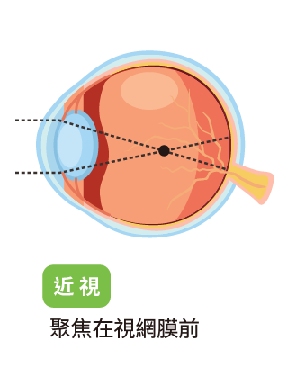 myopic-13