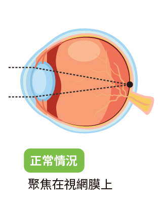 myopic-12