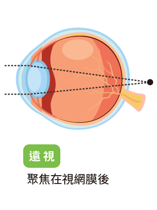 myopic-14