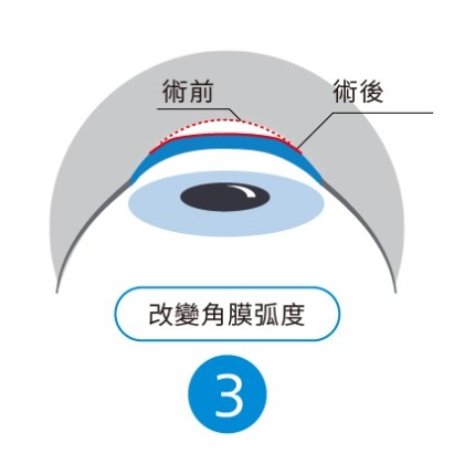 SMILE 全飛秒雷射手術步驟 3