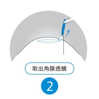 SMILE 全飛秒雷射手術步驟 2