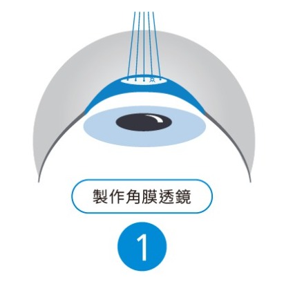 SMILE 全飛秒雷射手術步驟 1