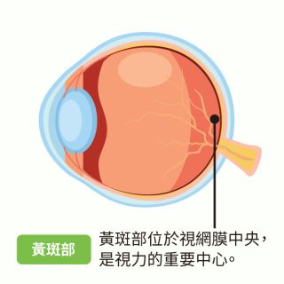 macular degeneration-03