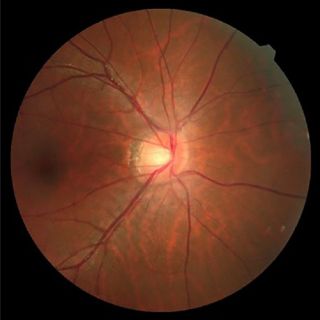 macular degeneration-01