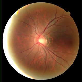 macular degeneration-02